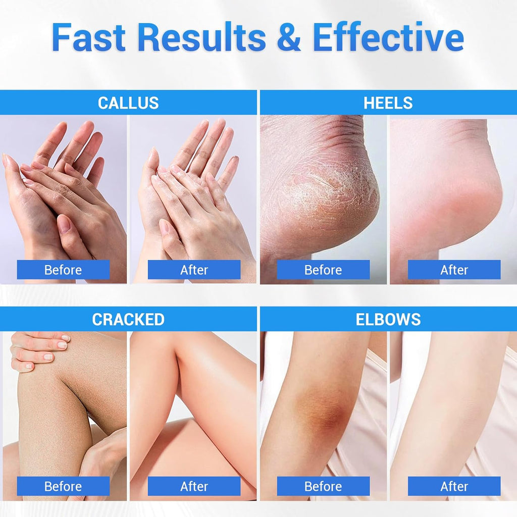 Sagry Urea Cream 40 Percent for Feet Maximum Strength, Foot Cream for Dry Cracked Heels Feet Knees Elbows Hands, Urea 40% Cream for Deep Moisturizes, Callus Remover, Heel Crack Repair