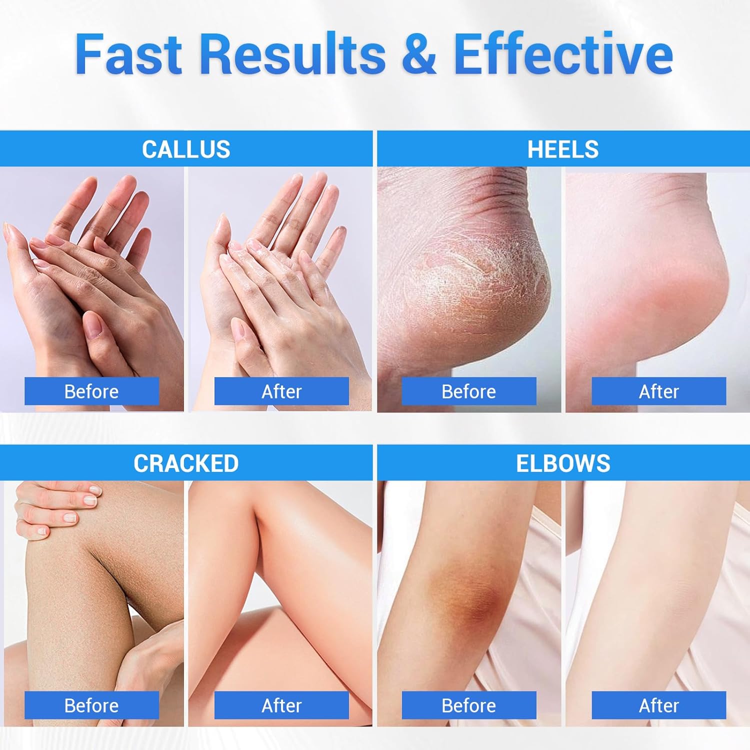 Sagry Urea Cream 40 Percent for Feet Maximum Strength, Foot Cream for Dry Cracked Heels Feet Knees Elbows Hands, Urea 40% Cream for Deep Moisturizes, Callus Remover, Heel Crack Repair