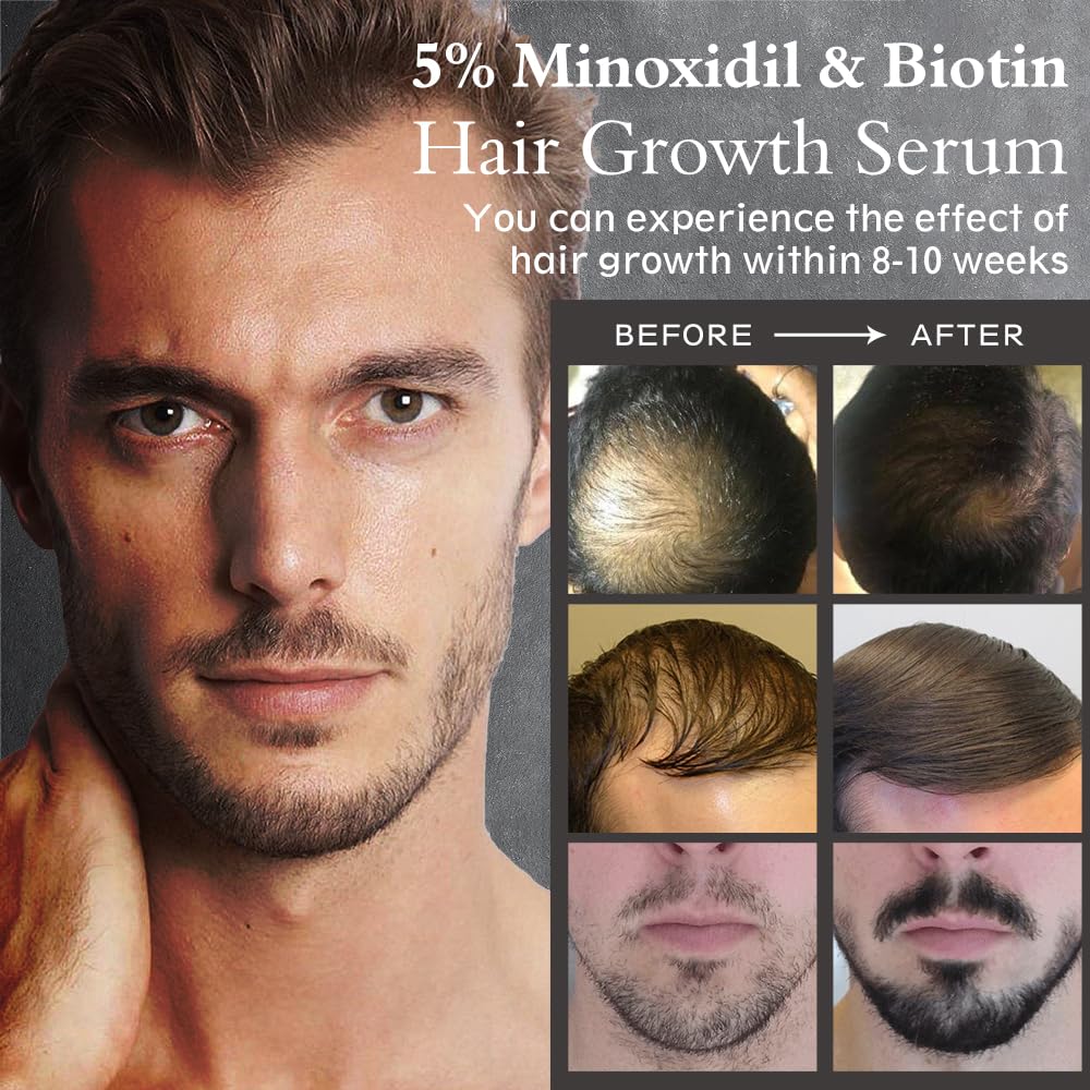 Ruahouine Hair Growth Treatment for Thicker Longer, 5% Minoxidil Biotin Hair Growth Serum Oil for Men and Women, Prevents Hair Loss and Thinning, 2.11 fl.oz