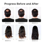 Minoxidil & Biotin Shampoo for Hair Growth - Enriched with Caffeine, Castor Oil & Onion - DHT Blocker for Thicker, Healthier Hair - Strengthening Formula for Men & Women
