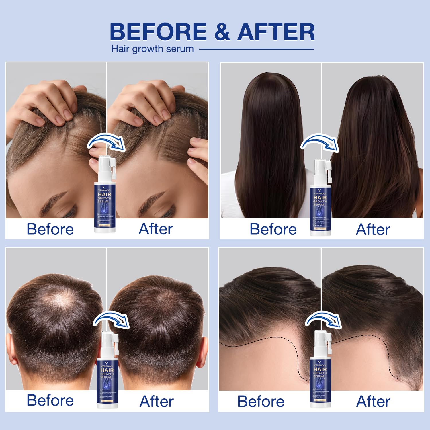 VENANOCI Hair Growth Oil Spray: Natural Hair Regrowth Serum with Rosemary, Biotin – Anti-Hair Loss Treatment for Thinning Hair – Promotes Thicker, Fuller Hair for Women & Men