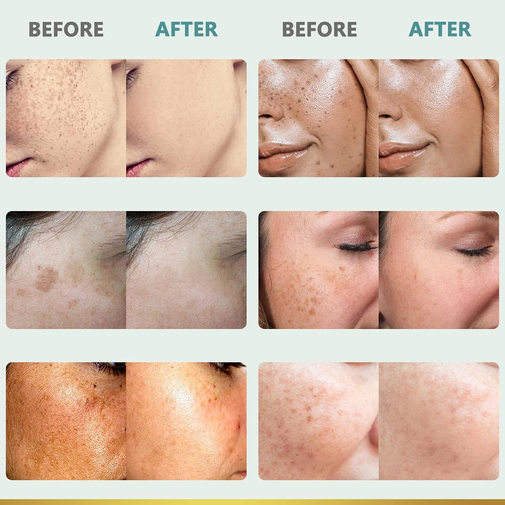 Citygoo Dark Spot Remover For Face: Dark Spot Corrector Cream - Enriching Skin Care For All Skin Tones - Melasma Freckle Sun Spot Remover & Blemish Reducer-1.7 Fl Oz