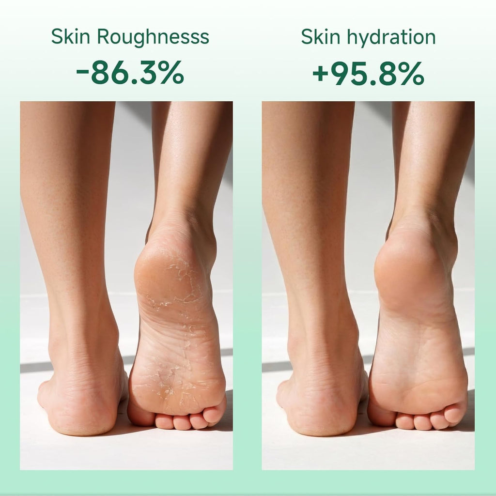 40% Urea Cream for Feet Maximum Strength, Foot Cream for Dry Cracked Heels, Callus Remover with 2% Salicylic Acid, Moisturizer for Hands Elbows Knees Rough Skin