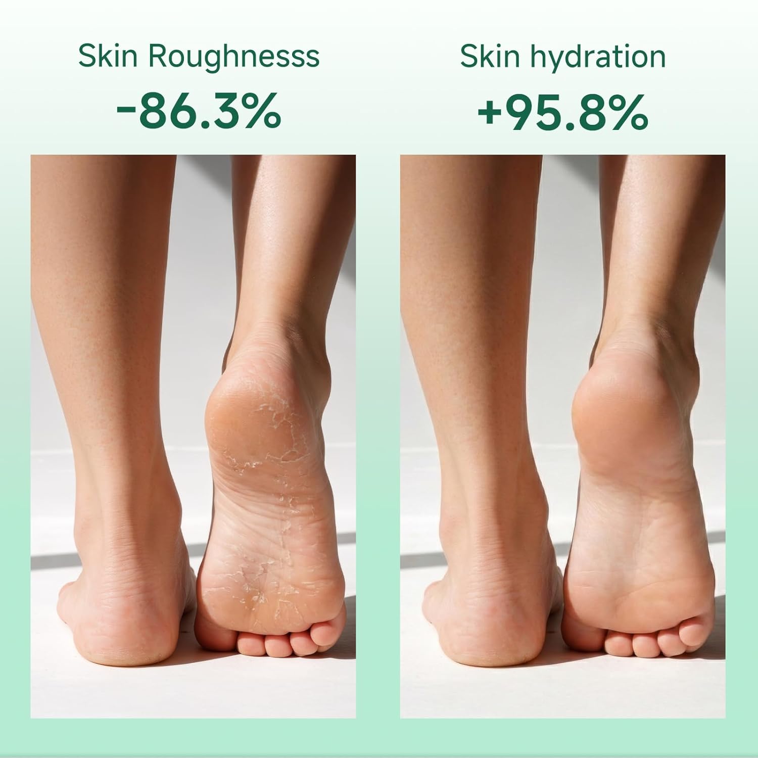 40% Urea Cream for Feet Maximum Strength, Foot Cream for Dry Cracked Heels, Callus Remover with 2% Salicylic Acid, Moisturizer for Hands Elbows Knees Rough Skin