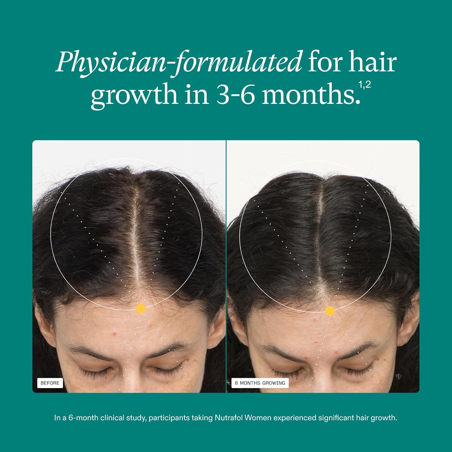 Nutrafol Women Hair Growth Supplements for Thinning Hair Ages 18-44 Clinically Tested for Visibly Thicker and Stronger Hair Dermatologist Recommended 1 Month Supply