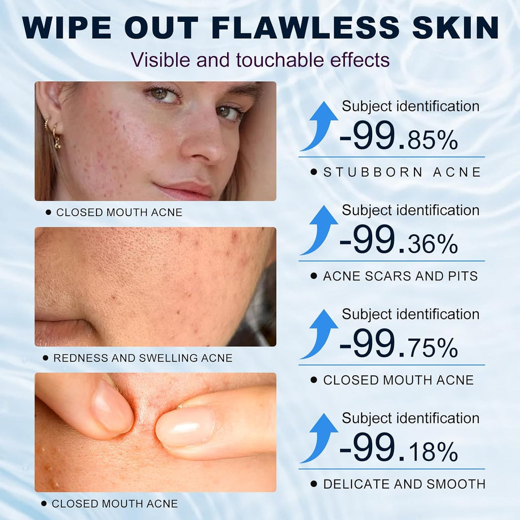 Azelaic Acid 10% Cream For Face - Acne Cream For Rosacea Reducing Relief Pimple Breakouts Blackhead Pigmentation And Redness - Azelaic Acid Gel For Facial And Skin Care