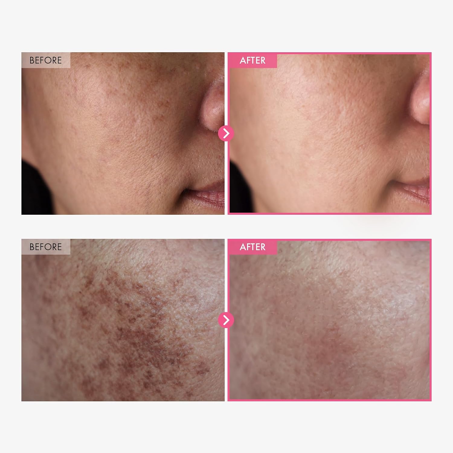 Tosowoong Arbutin 7% + Tranexamic Acid 4% Cream, 70,000Ppm Arbutin, 40,000Ppm Txa, Niacinamide, Glutathione, Dark Spots, Freckle, Blemishes, Pigmentation, Korean Skin Care, 50Ml, 1.69 Fl.Oz.