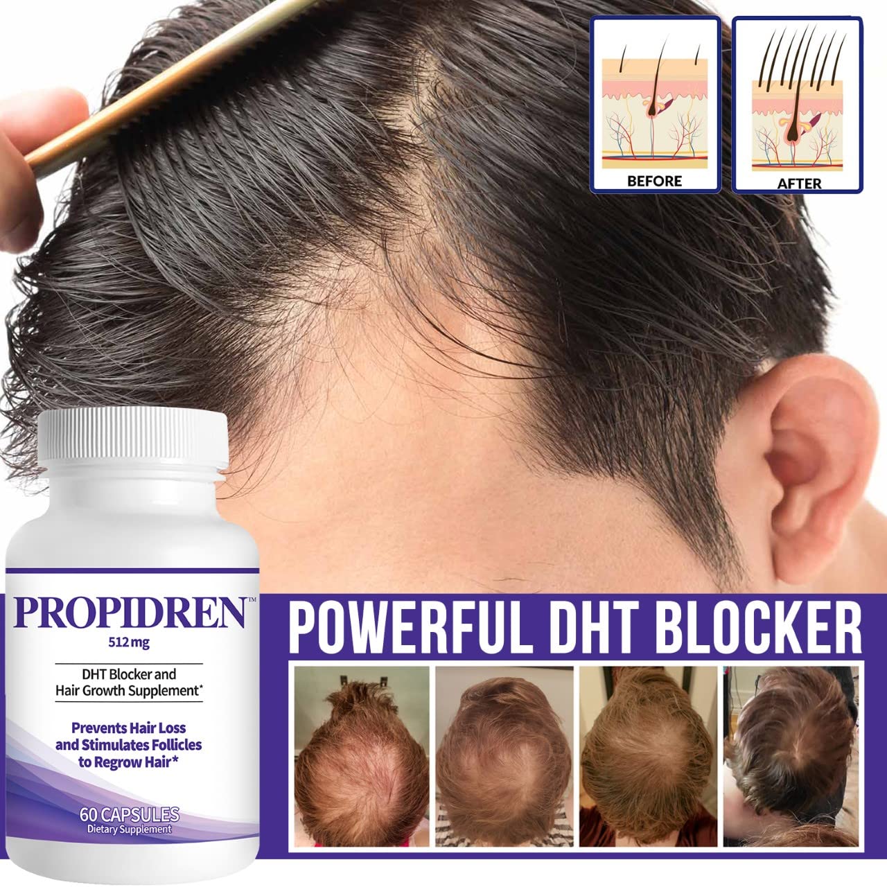 Propidren Dht Blocker & Hair Growth Pills To Stop Hair Loss And Regrow Hair | Prevents Hair Loss