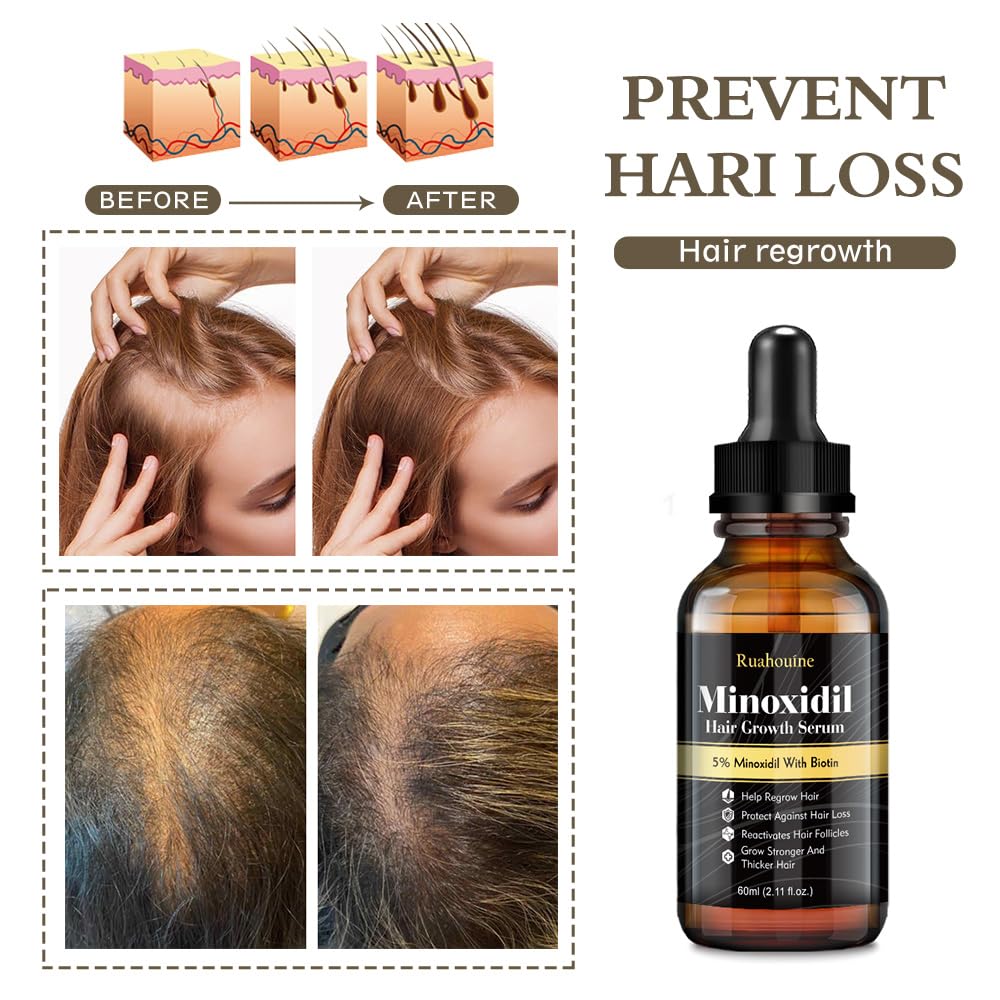 Ruahouine Hair Growth Treatment for Thicker Longer, 5% Minoxidil Biotin Hair Growth Serum Oil for Men and Women, Prevents Hair Loss and Thinning, 2.11 fl.oz