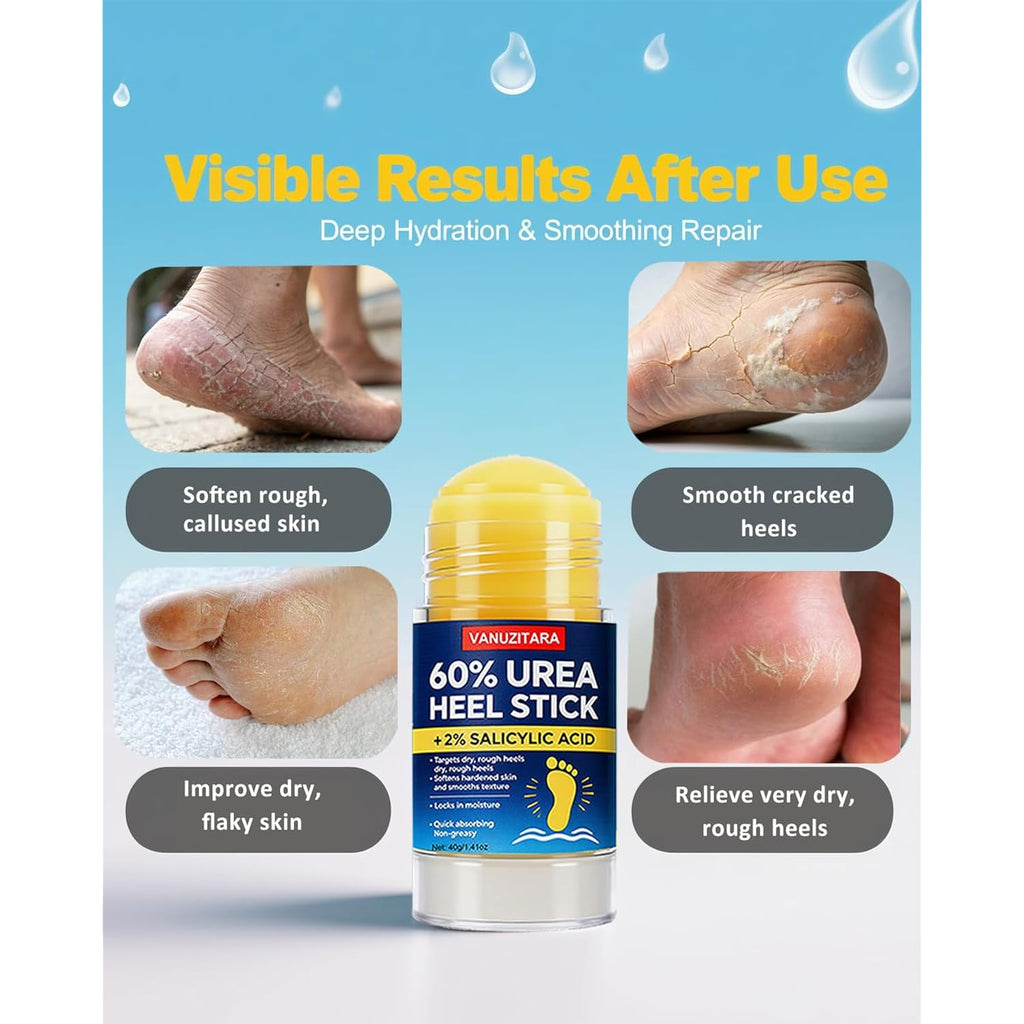 Urea Cream 60% with 2% Salicylic Acid, Foot Cream 60 Percent for Feet & Hands, Maximum Strength Urea Stick for Rough, Dry Cracked Feet Hands Elbows, Callus Remover, Skin Softener Balm 1.41oz
