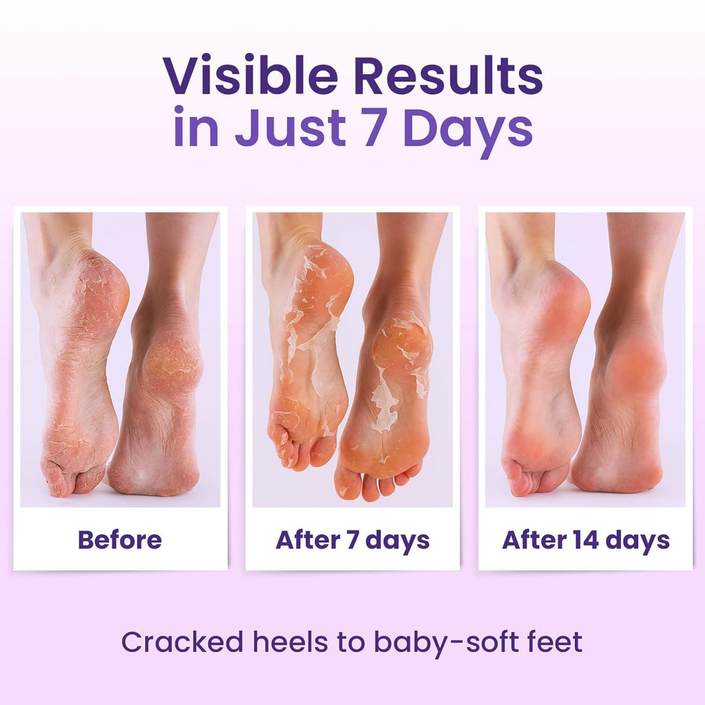 Foot Peeling Mask (6 pairs) Exfoliating Foot Mask for Dry Cracked Feet with Lavender & Shea Butter, Dead Skin & Callus Remover for Feet, Exfoliating Socks for Women & Men, One Size Fits Most