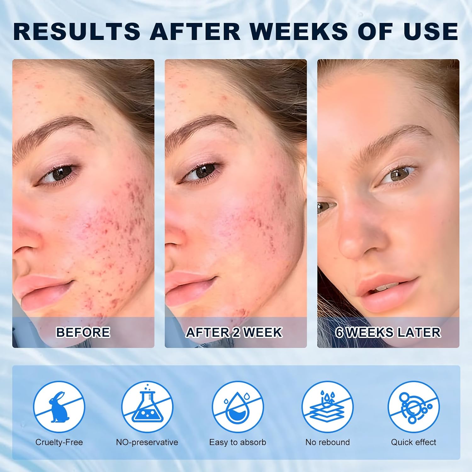 Azelaic Acid 10% Cream For Face - Acne Cream For Rosacea Reducing Relief Pimple Breakouts Blackhead Pigmentation And Redness - Azelaic Acid Gel For Facial And Skin Care