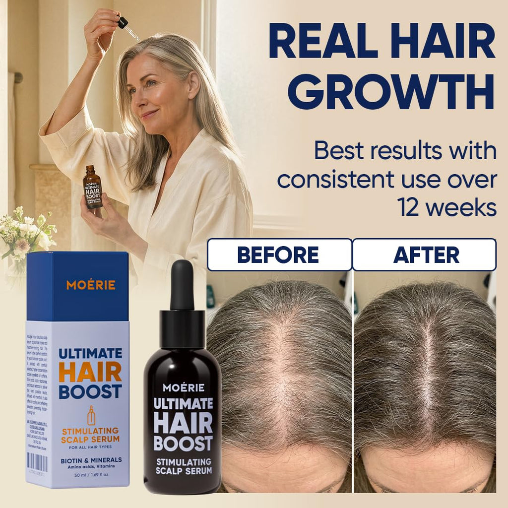 Moerie Ultimate Hair Growth Serum For Natural Hair Regrowth & Thickening - Anti Thinning & Hair Loss Treatment For Women - Rapid Hair Growth Products - Scalp Oil Alternative - 1.69 Fl Oz / 50 Ml