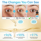 Eye Serum For Chalazion & Blepharitis, 30Ml Chalazion Remover For Eyelid, Blepharitis Eyelid Serum With Avocado Oil, Sea Buckthorn Oil & Caffeine, Relieve Puffiness And Eye Fatigue