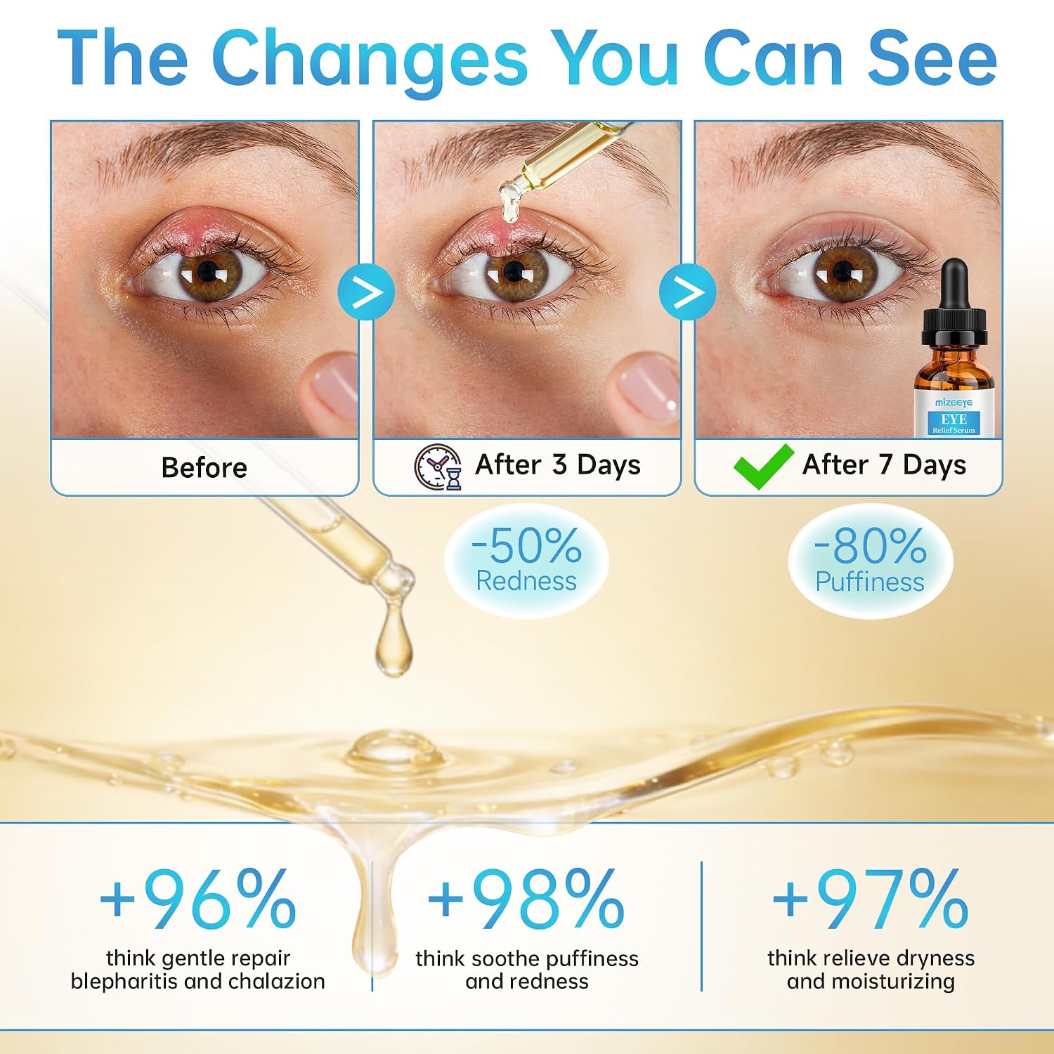 Eye Serum For Chalazion & Blepharitis, 30Ml Chalazion Remover For Eyelid, Blepharitis Eyelid Serum With Avocado Oil, Sea Buckthorn Oil & Caffeine, Relieve Puffiness And Eye Fatigue