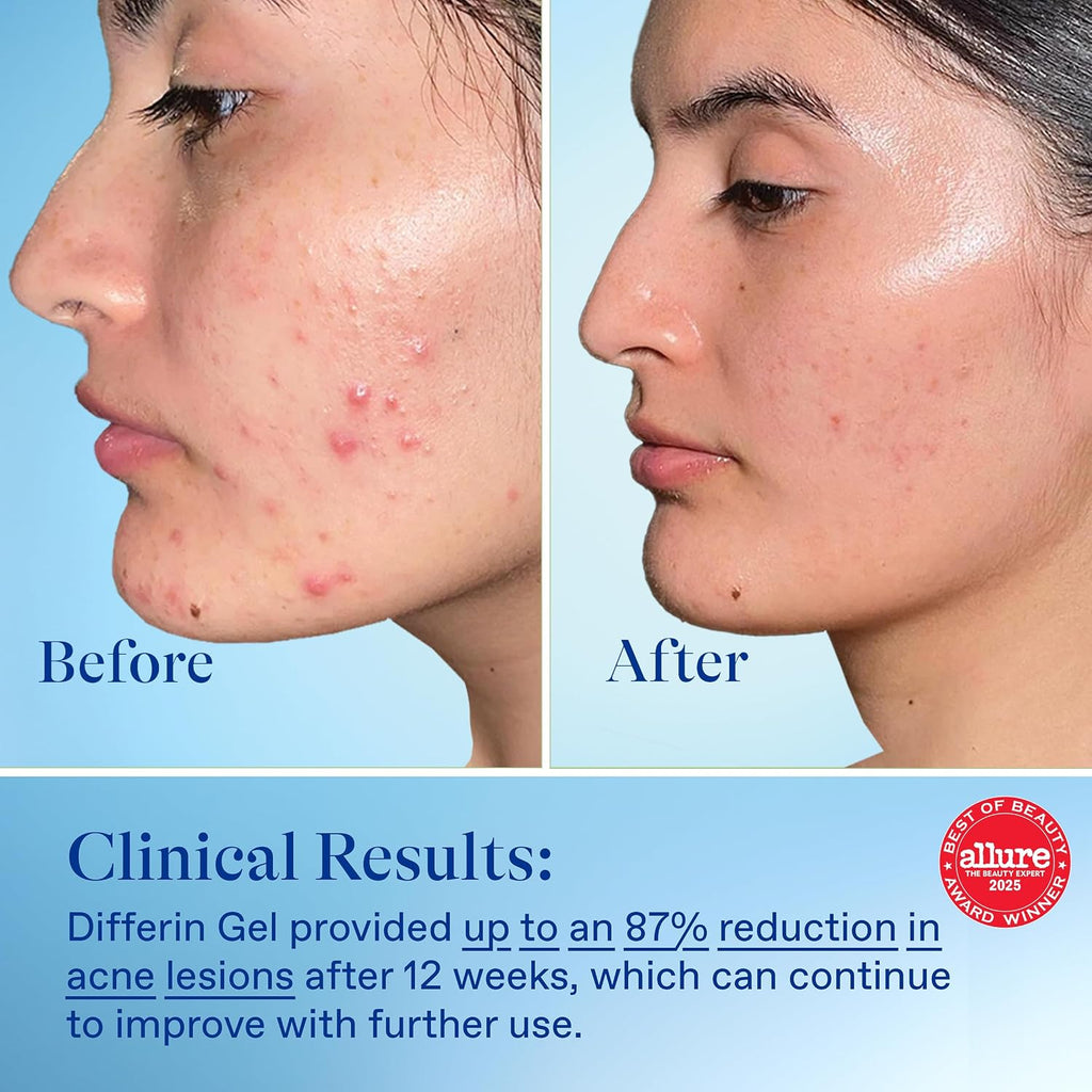 Differin Acne Treatment Gel, 90 Day Supply, Retinoid Treatment For Face With 0.1% Adapalene, Gentle Skin Care For Acne Prone Sensitive Skin, 45G Pump (Packaging May Vary)