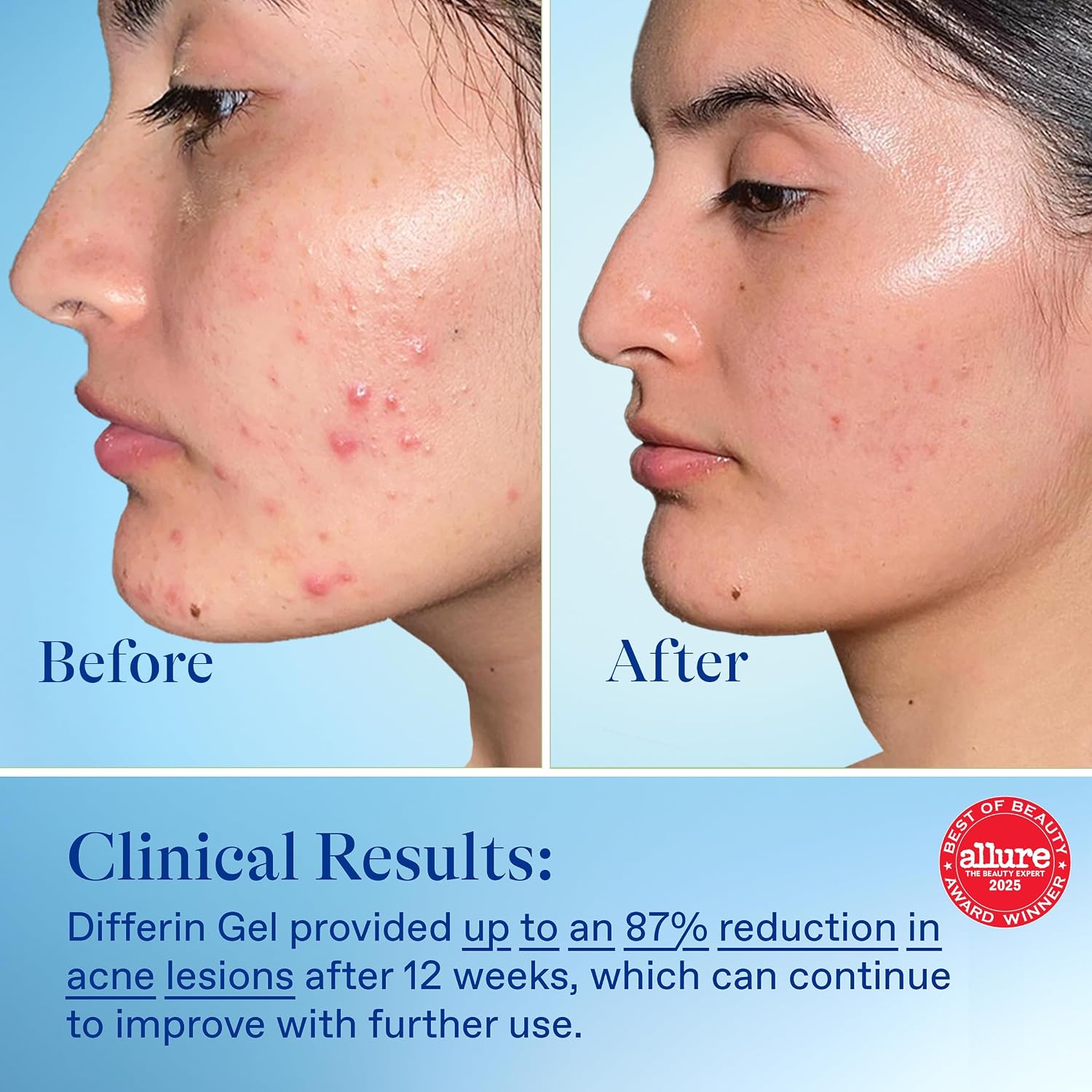 Differin Acne Treatment Gel, 90 Day Supply, Retinoid Treatment For Face With 0.1% Adapalene, Gentle Skin Care For Acne Prone Sensitive Skin, 45G Pump (Packaging May Vary)