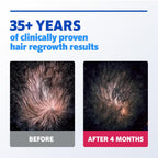 Men’s Rogaine Extra Strength 5% Minoxidil, Topical Solution for Thinning & Hair Loss, Clinically Proven FDA Approved Minoxidil for Men Treatment, Regrow Fuller Hair, 3 Month Supply, 3 Bottles