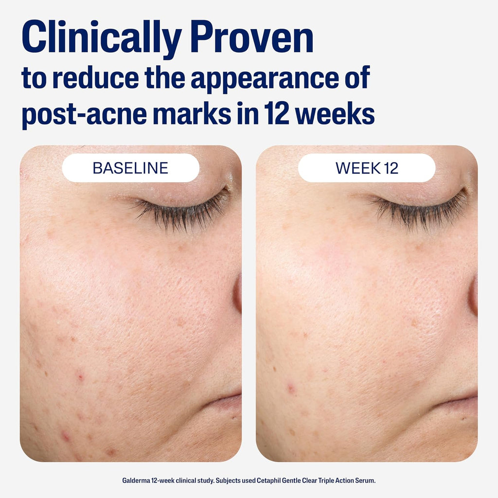 Cetaphil Gentle Clear Repairing Post-Acne Serum, Retinol Alternative, Oil Free Serum For Sensitive Skin, 1 Fl Oz, Bakuchiol, Improves Skin Tone & Post-Acne Marks, Dermatologist Recommended Brand