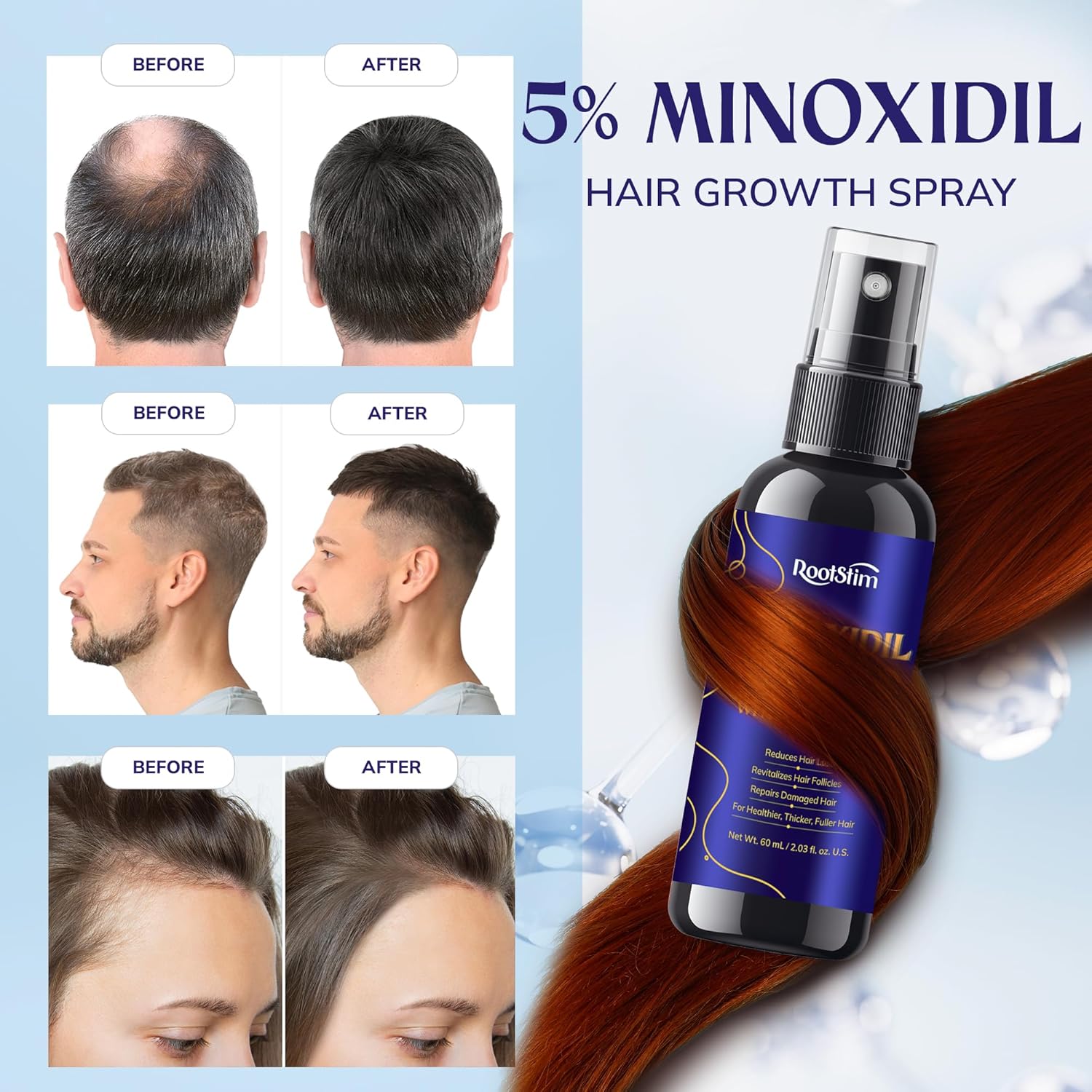 5% Minoxidil Hair Growth for Men and Women: 3-Pack RootStim Extra Strength Minoxidil Beard Regrowth Treatment with Rosemary for Thinning Hair Regrowth and Fuller Hair 180 ML