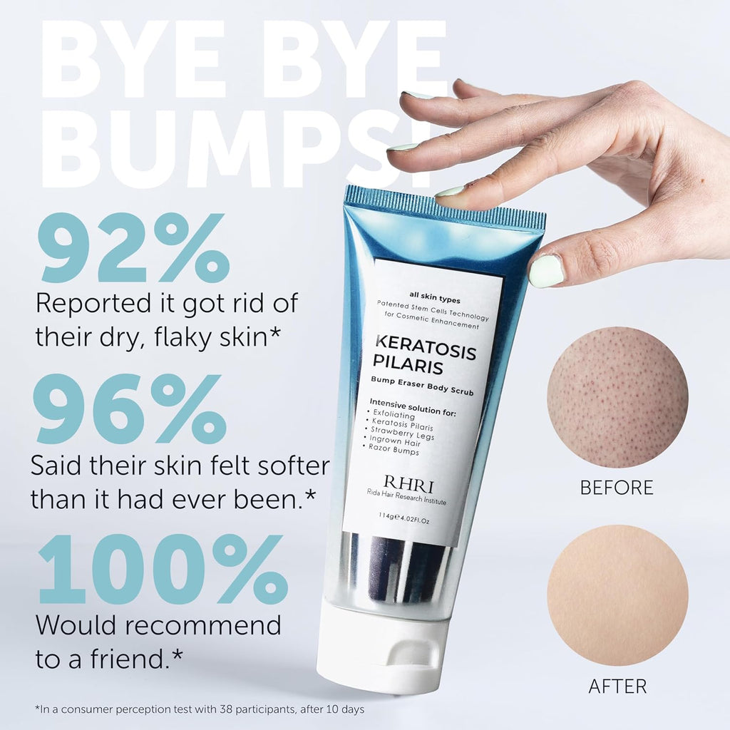 Kp Bump Eraser Body Scrub With 10% Aha | Keratosis Pilaris Treatment | Bump Eraser Body Scrub | Ingrown Hair Treatment | Clears Strawberry Legs | Soothes Redness, Dryness & Flaky Skin