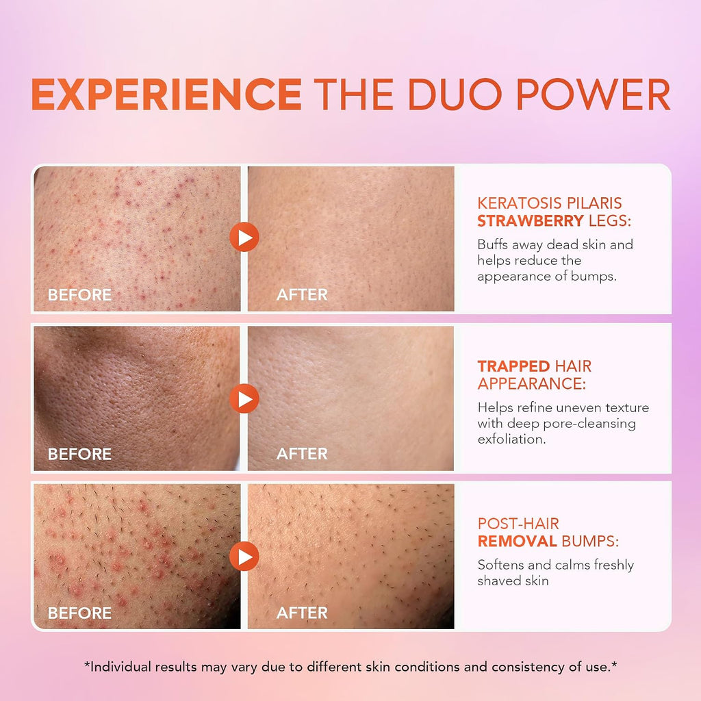 Kp Bump Eraser Body Scrub & Keratosis Pilaris Lotion Set With 10% Aha + Bha – Strawberry Legs Treatment For Women & Man - Exfoliates & Deeply Hydrates For Smoother Healthy-Looking Skin