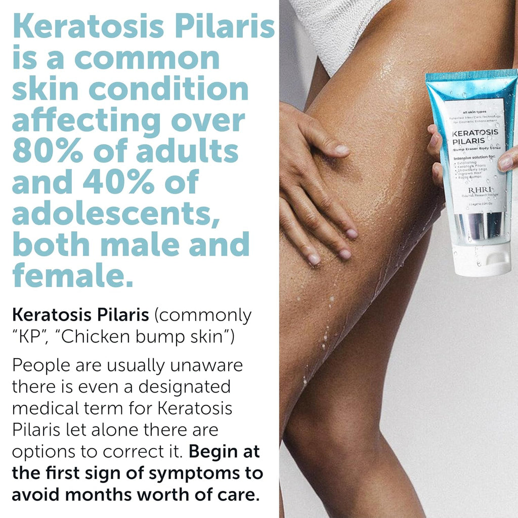 Kp Bump Eraser Body Scrub With 10% Aha | Keratosis Pilaris Treatment | Bump Eraser Body Scrub | Ingrown Hair Treatment | Clears Strawberry Legs | Soothes Redness, Dryness & Flaky Skin