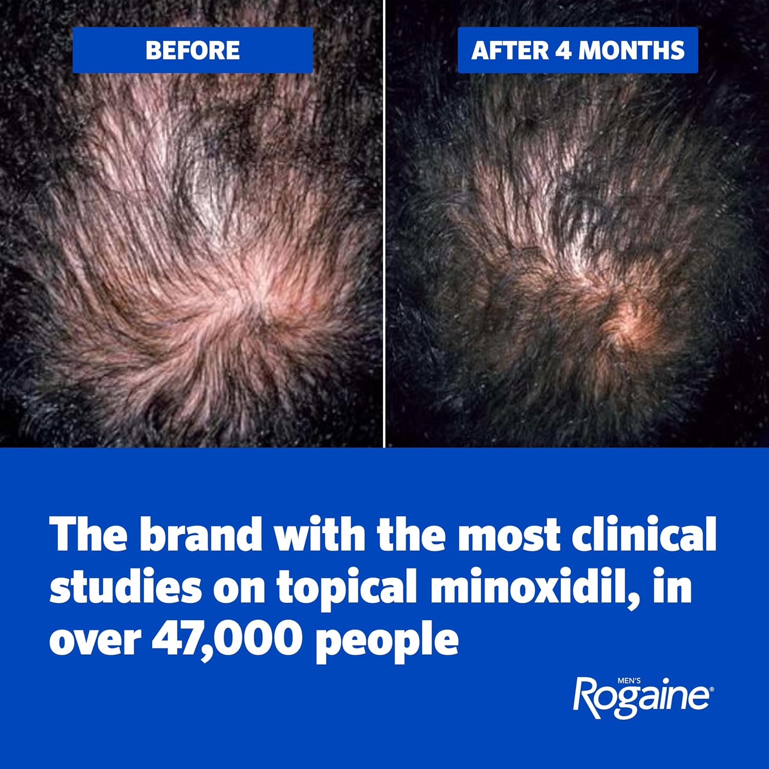 Men'S Rogaine Extra Strength 5% Minoxidil Solution, 3 Mo Supply, 3X 2 Fl Oz