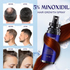Rootstim Minoxidil 5% Hair Growth Spray For Men And Women | Fast-Drying Lightweight Formula, Thinning Hair Regrowth | Rosemary, Biotin, Caffeine | Daily Use | 2 Fl Oz