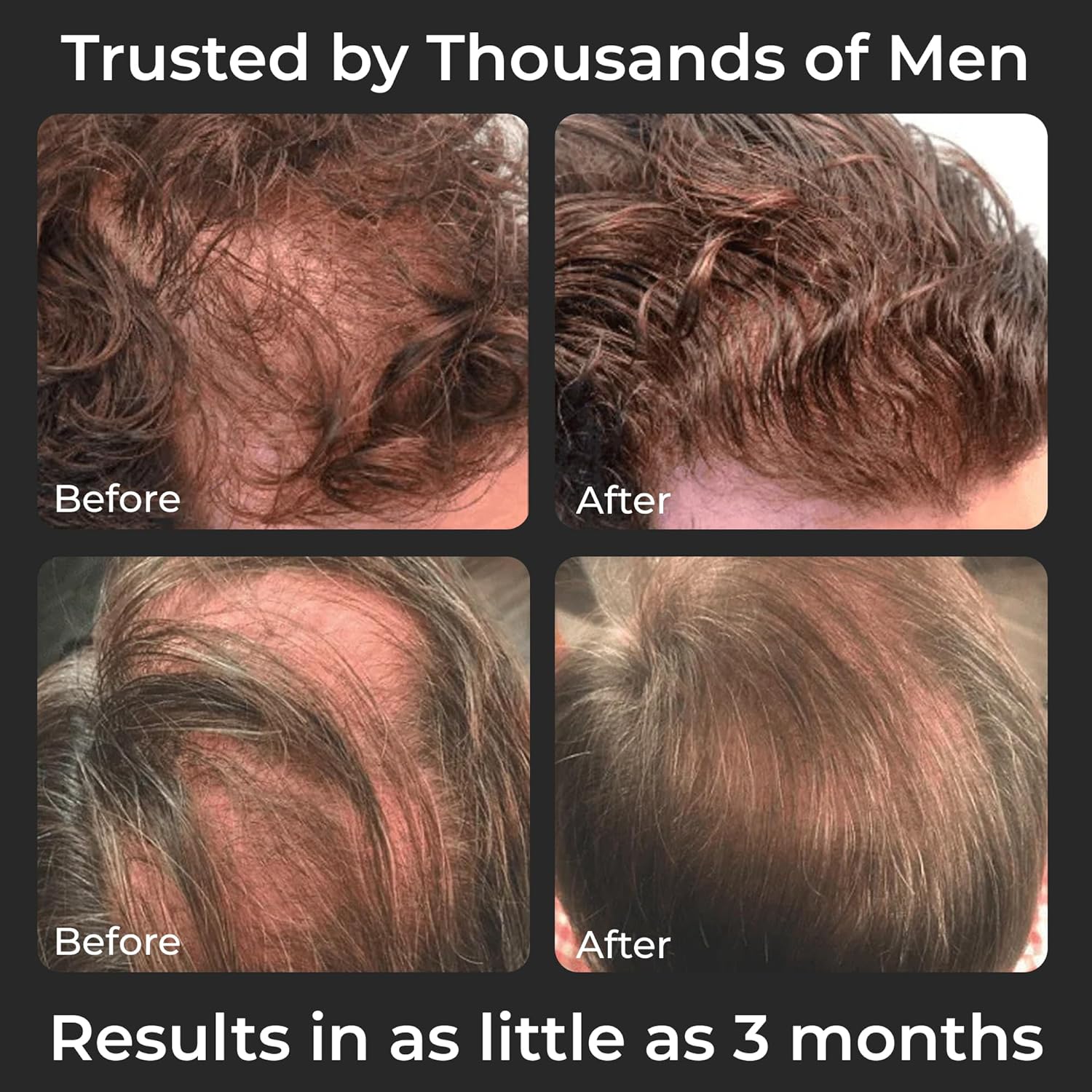 SPARTAN™ Root Activator Shampoo For Men - Hair Growth Shampoo for Hair Loss and Thinning Hair