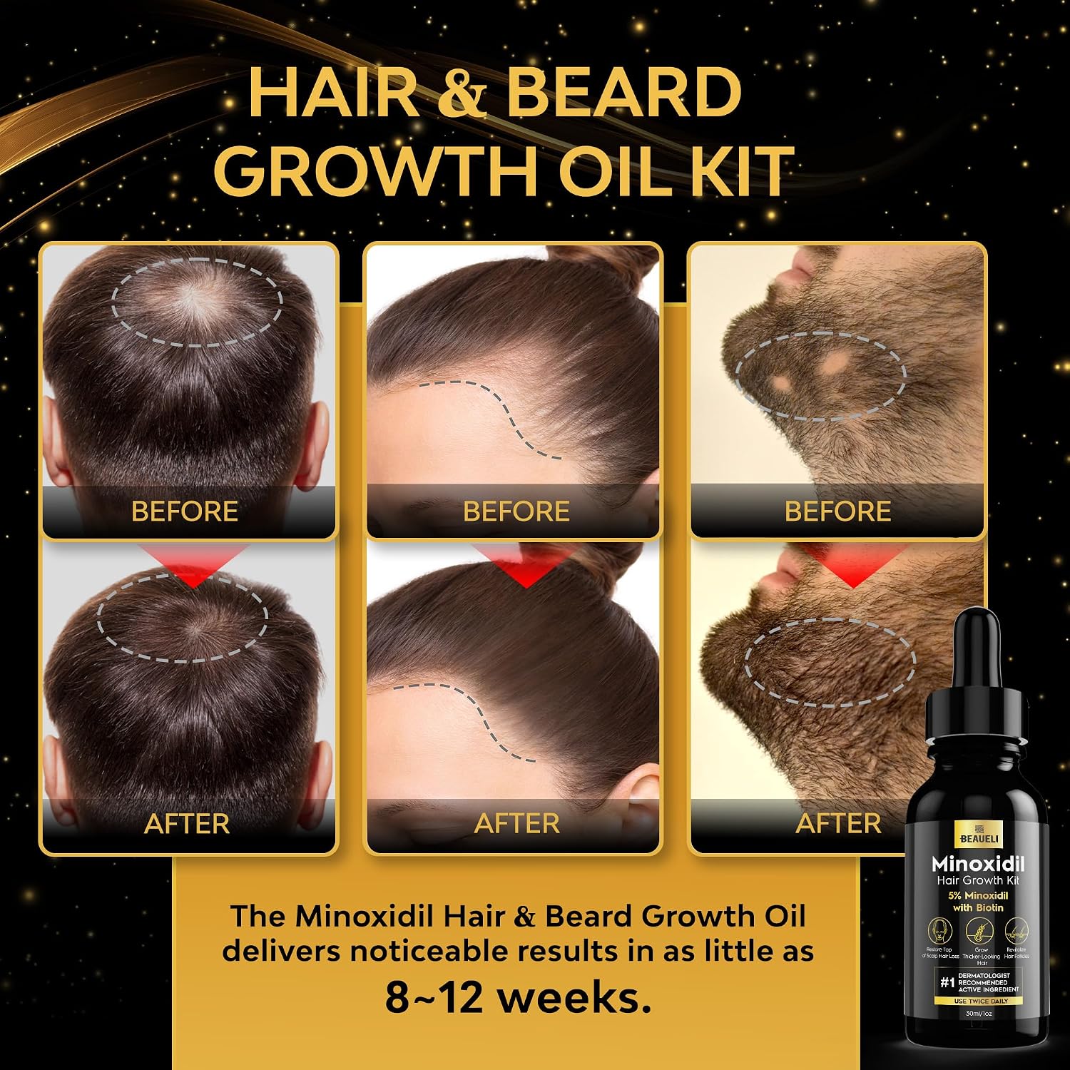 Beaueli Minoxidil Beard Growth Kit For Men And Women, Hair Loss And Hair Regrowth Treatments, Minoxidil 5%, Black