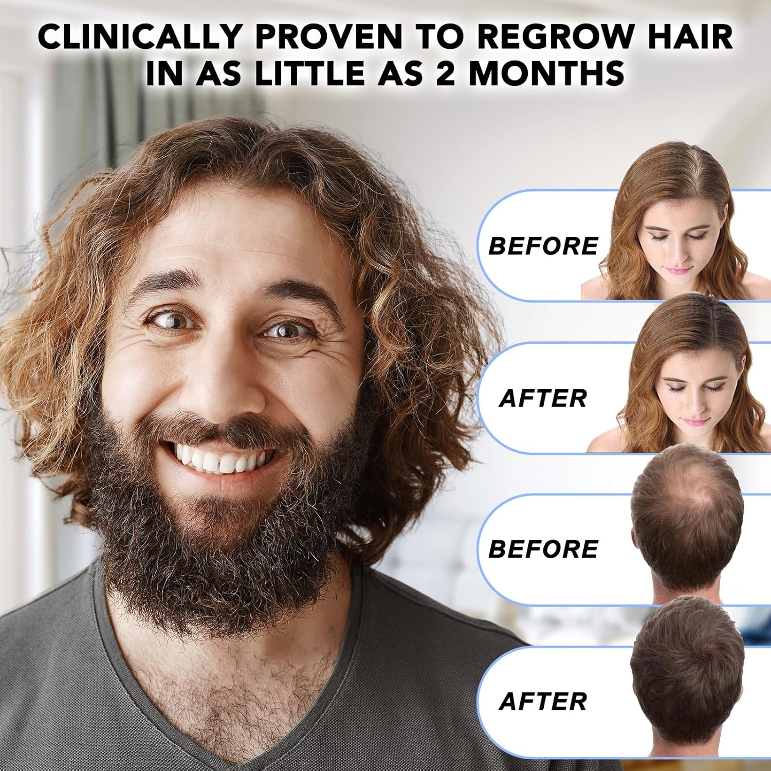 Minoxidil for Men-5% Extra Strength Hair Regrowth for Men Treatment-5% Topical Solution-Dropper Applicator Included -Minoxidil for Women-Stop Thinning & Hair Loss (1)