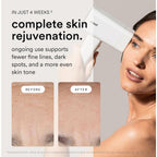 Nood™ Flasher Pro — Forbes Best Product 2026 — IPL Laser Hair Removal Device For At Home Use — Pain-Free, Permanent, Visible Results After First Use & Works Everywhere Hair Grows — Gloss White