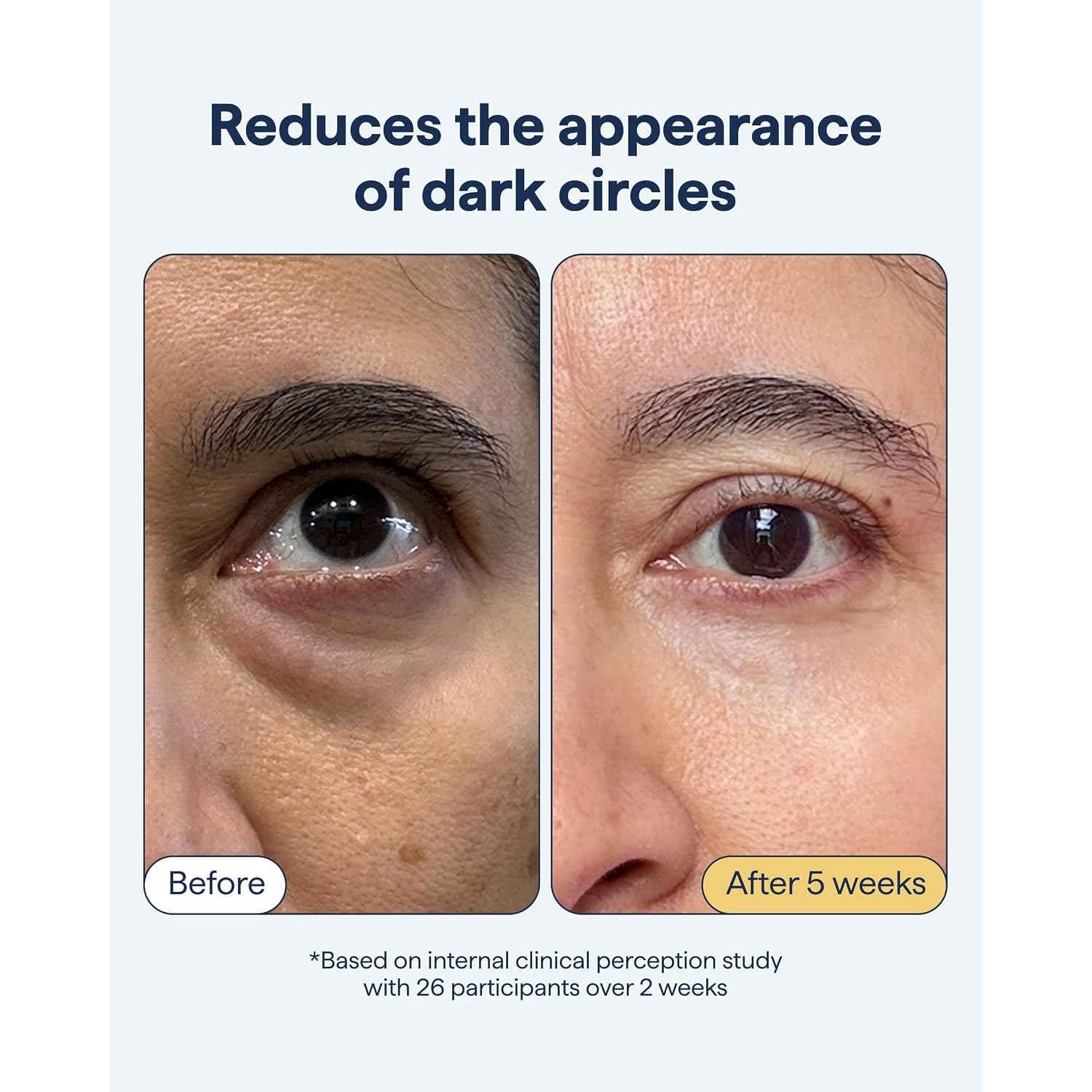 Remedy Dark Circles Reducing Advanced Eye Cream | Undereye Discoloration Treatment | Caffeine, Kojic Acid, Niacinamide, Marine Algae Complex | By Dermatologist Dr. Shah, 0.5 Fl. Oz