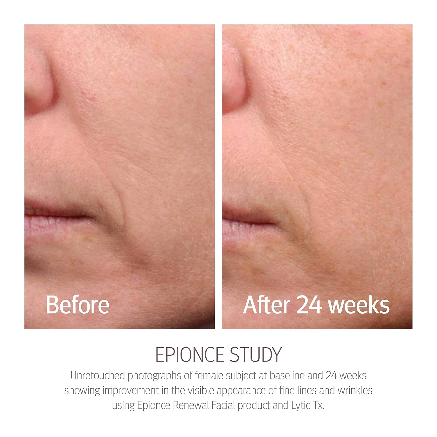 Epionce Renewal Facial Lotion - Hydrating, Anti-Aging Moisturizer For Normal To Combination Skin, For Fine Lines & Wrinkles, Dermatologist Skincare