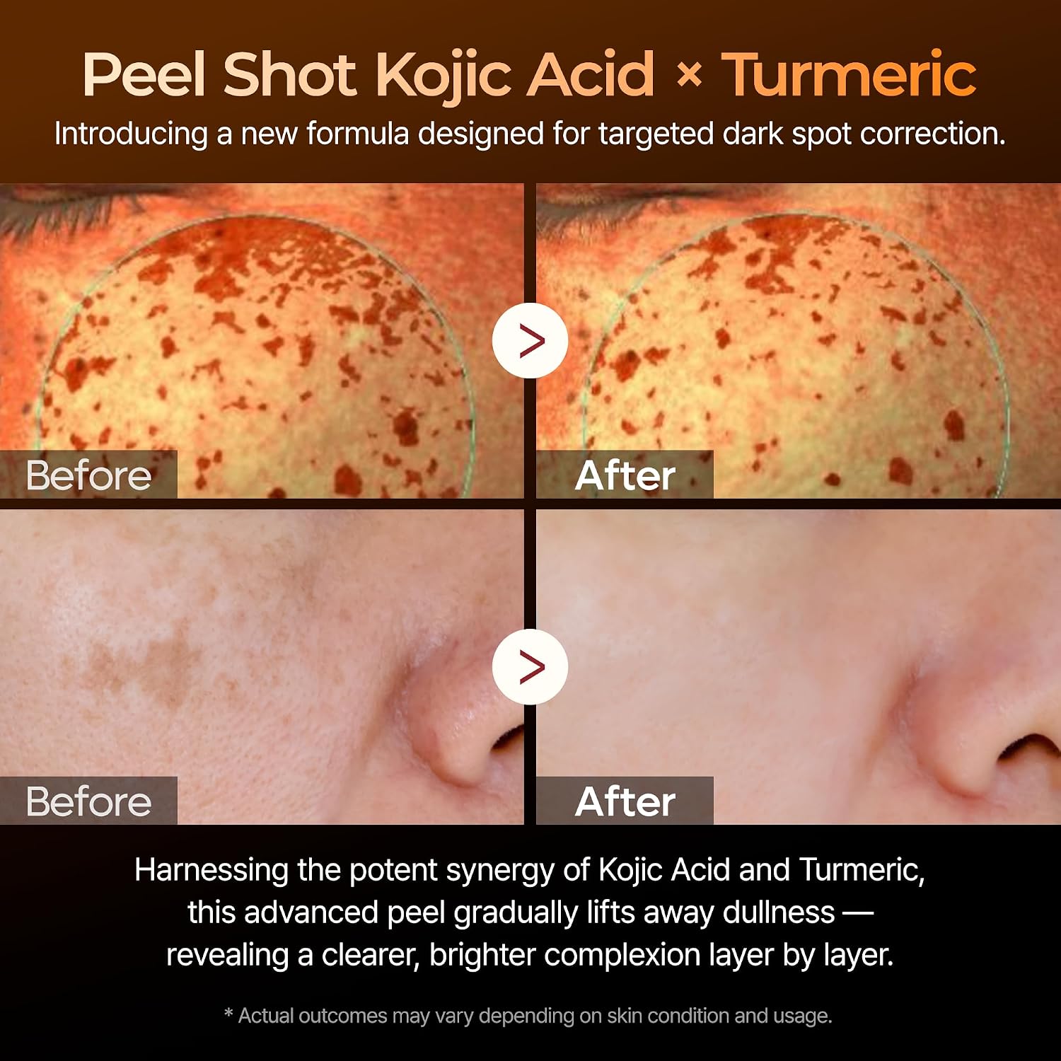 Dr. Melaxin Peel Shot Kojic Acid Turmeric Serum – Exfoliating Dark Spot Corrector With Aha/Bha & Niacinamide, Brightening & Even Tone Facial Serum (80Ml / 2.70 Fl Oz)