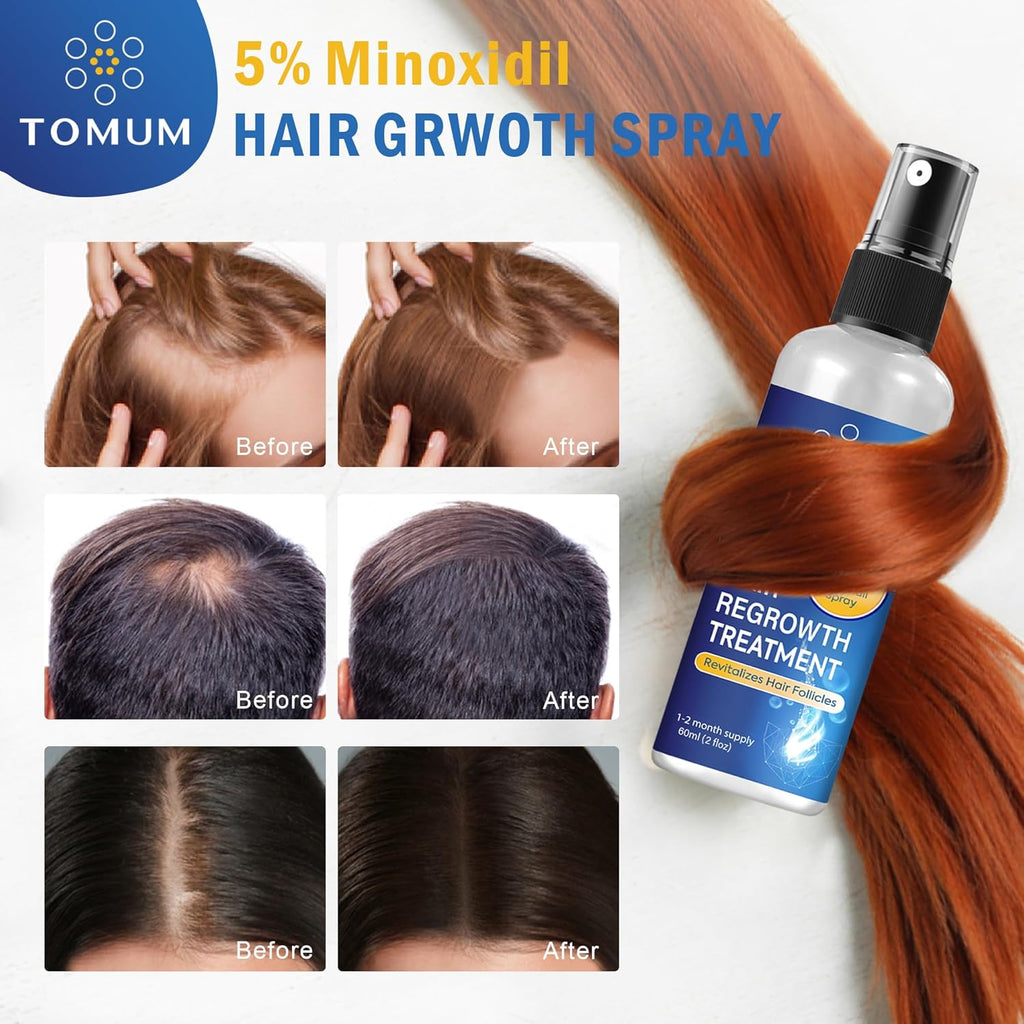 Minoxidil for Men and Women Hair Growth: 5% Minoxidil Topical Spray Hair Regrowth Treatment Stop Hair Thinning and Hair Loss For Stronger Thicker Longer Hair 60ml 2 Pack