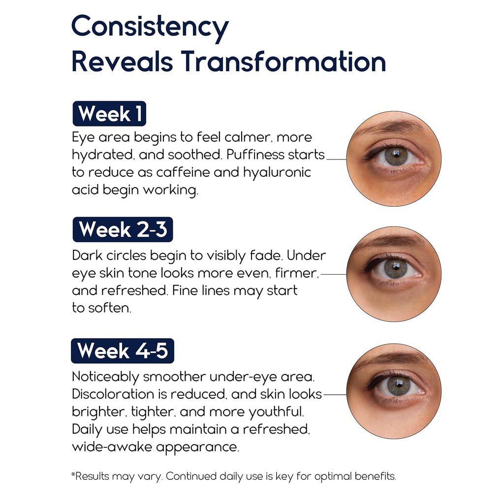 Under Eye Cream For Puffiness And Bags Under Eyes - Eye Bags Treatment For Men & Women - Anti Wrinkle Cream For Dark Circles, Baggy Eyes Treatment For Women With Retinol, Hyaluronic Acid & Caffeine