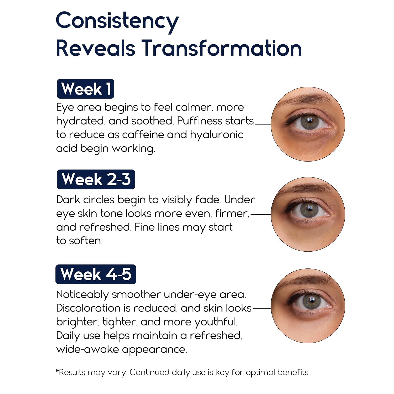 Under Eye Cream For Puffiness And Bags Under Eyes - Eye Bags Treatment For Men & Women - Anti Wrinkle Cream For Dark Circles, Baggy Eyes Treatment For Women With Retinol, Hyaluronic Acid & Caffeine