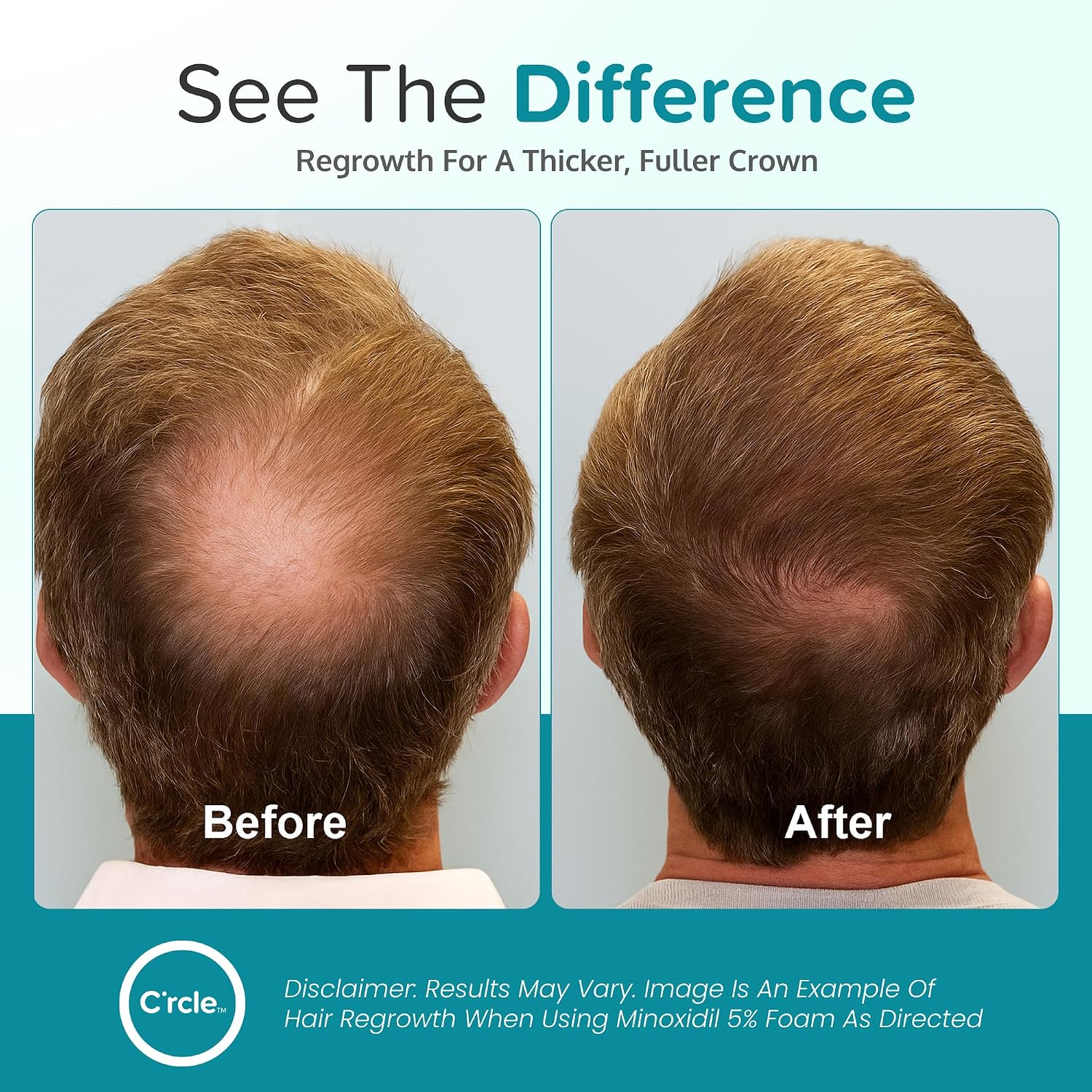 Minoxidil For Men Foam 5% - Unscented 3 Month Supply - Helps Restore Vertex Hair Loss & Thinning - 5% Minoxidil Foam For Men - Extra Strength Supports Hair Regrowth