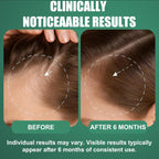 5% Minoxidil For Men And Women Hair Growth, Minoxidil Hair Growth Spray With Biotin & Rosemary, Extra Strength Hair Loss Treatment Serum For Thicker Hair & Beard Regrowth, 2 Bottles