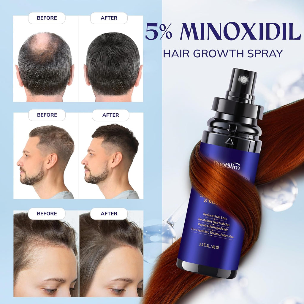 5% Minoxidil Hair Growth for Men and Women: 2-Pack Extra Strength Minoxidil Hair Loss Treatment Serum with Rosemary for Faster Stronger Thicker Hair Growth - 4 FL OZ