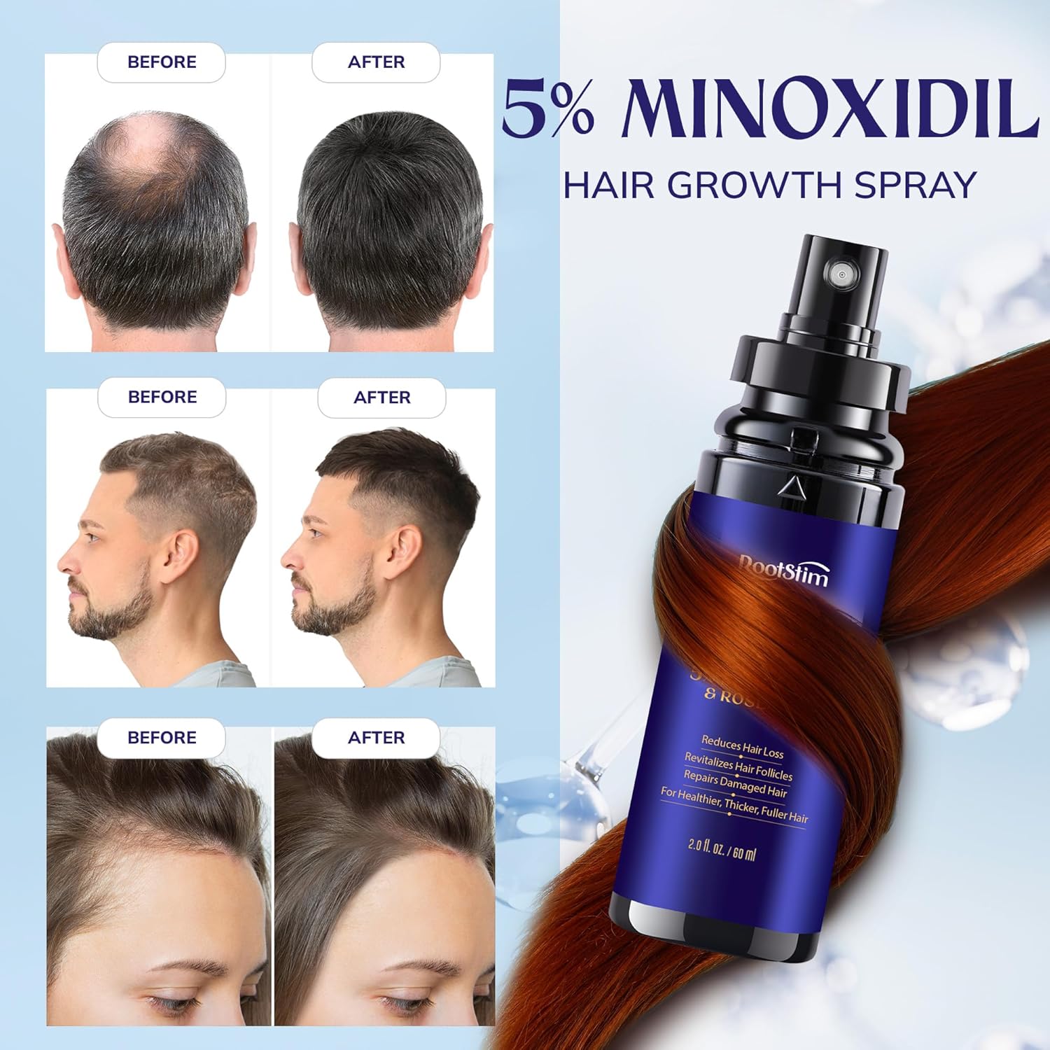 5% Minoxidil Hair Growth for Men and Women: 2-Pack Extra Strength Minoxidil Hair Loss Treatment Serum with Rosemary for Faster Stronger Thicker Hair Growth - 4 FL OZ