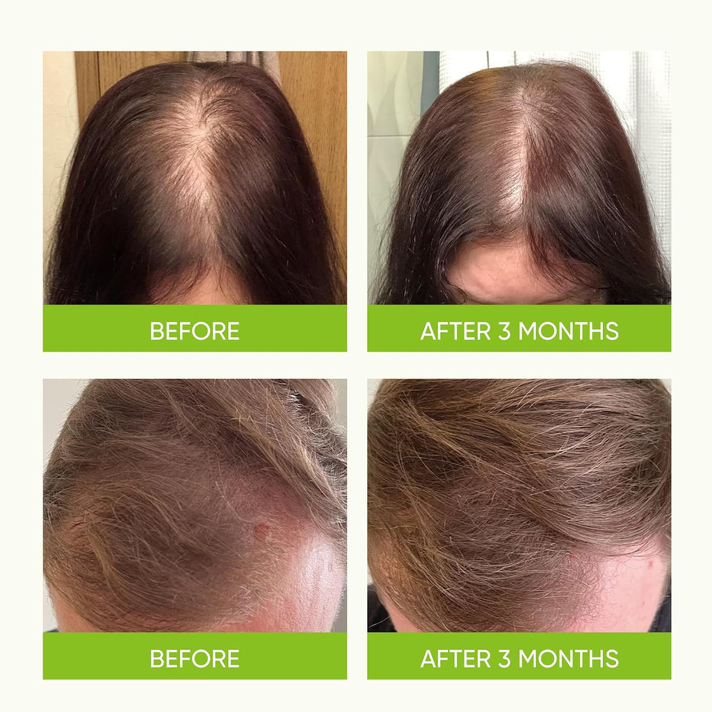 Hair Growth Serum Spray - With Rosemary Batana Oil Biotin For Hair Loss And Thinning Hair - Thicker Fuller Hair For Women Men 2 Fl Oz (Pack Of 1)
