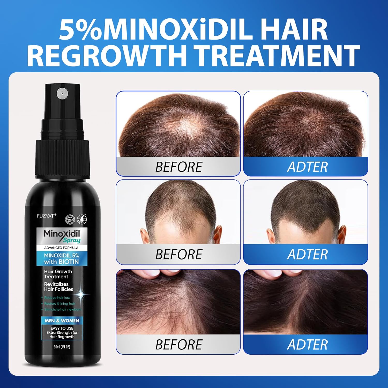 5% Minoxidil for Men Hair Loss Treatment, Minoxidil for Women Hair Growth Spray, For Men & Women, Supports Thinning Hair, With Biotin, Easy Daily Application (60ml)