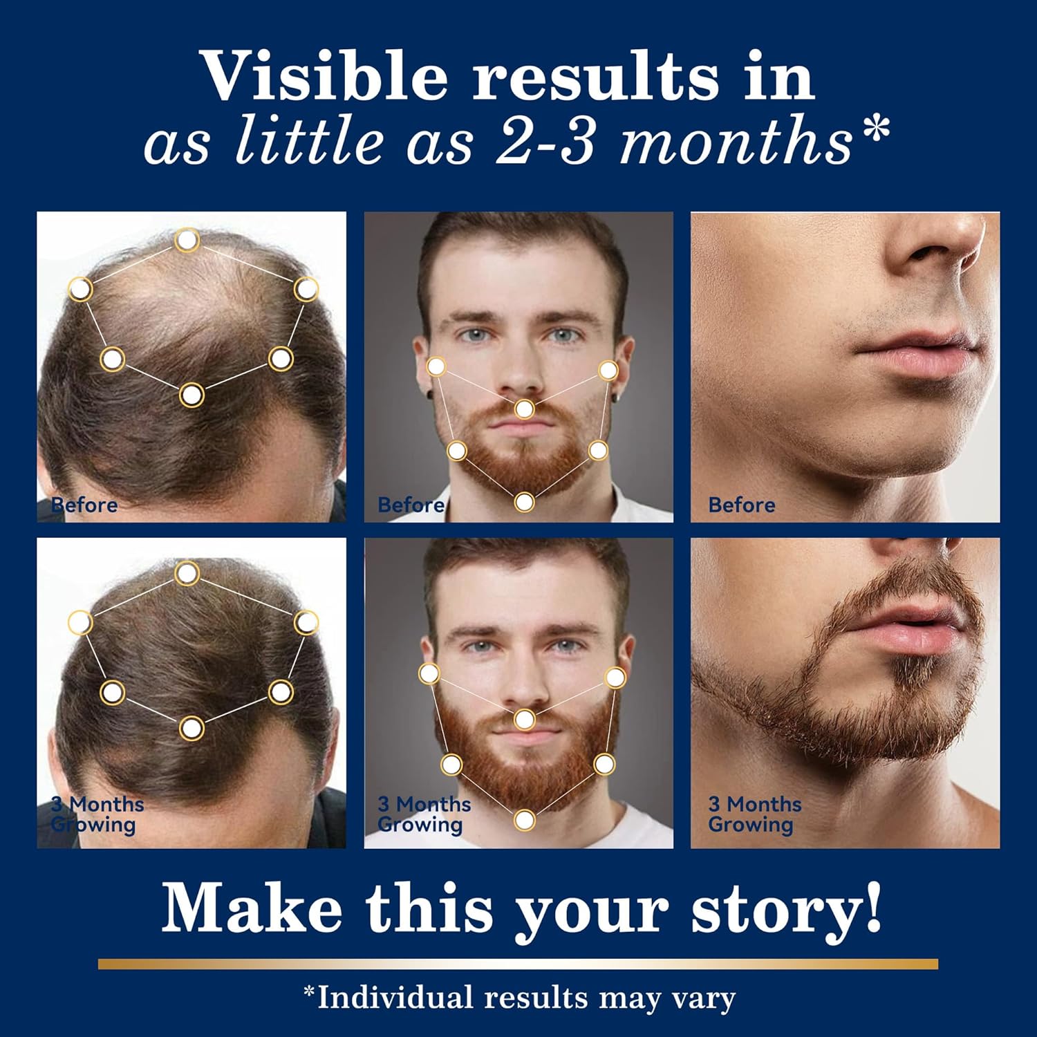 5% Minoxidil Hair Growth for Men and Women: Regrowth Topical Solution for Beard Spray Kit - Extra Strength Treatment with Minoxidil and Biotin for Hair loss & Thinning to Grow Thicker Serum - 2PCS