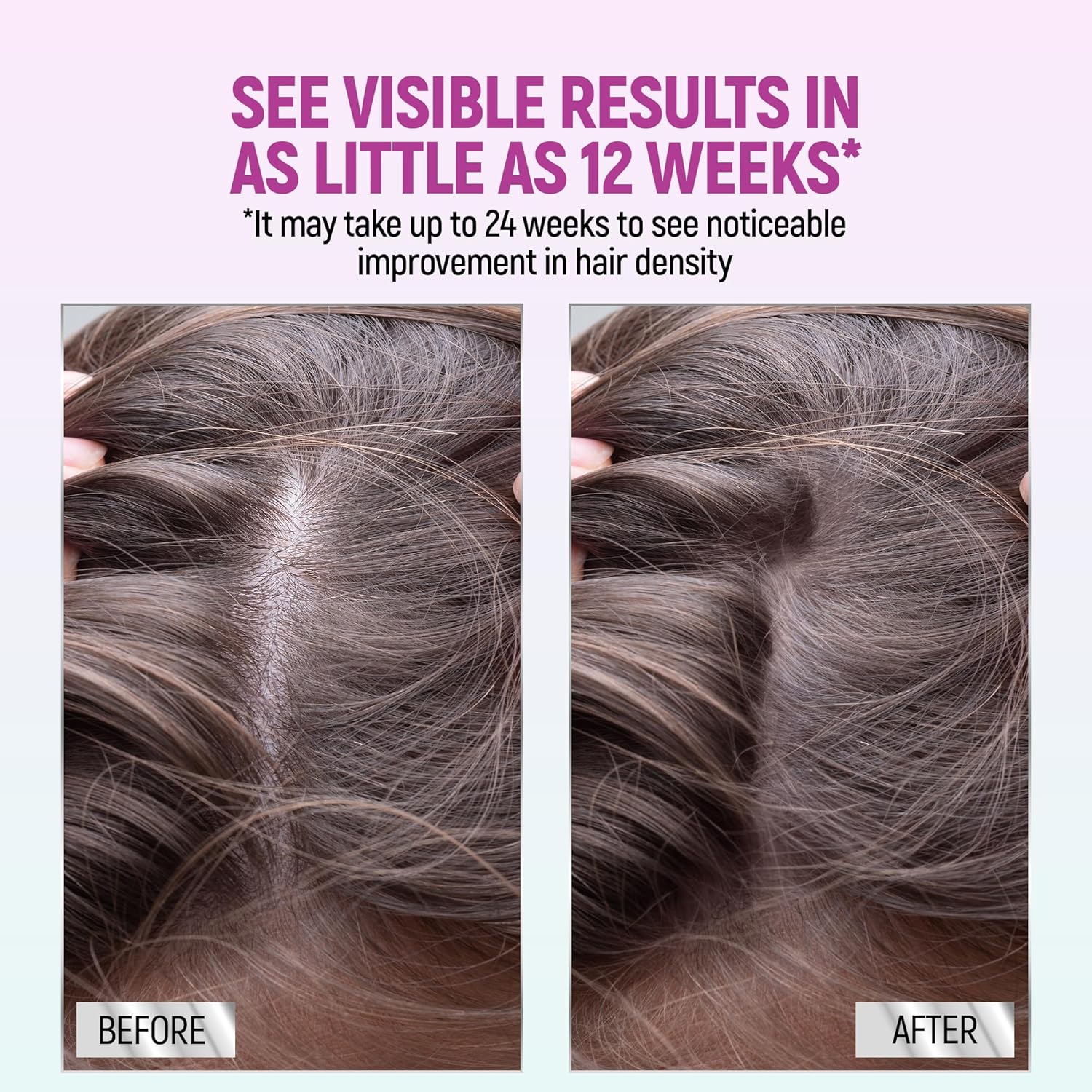 Minoxidil for Women, 2.11 Oz (2 Months Supply) Clinically Proven to Regrow Hair, Topical Aerosol Foam 5%, Hair Thinning Treatment