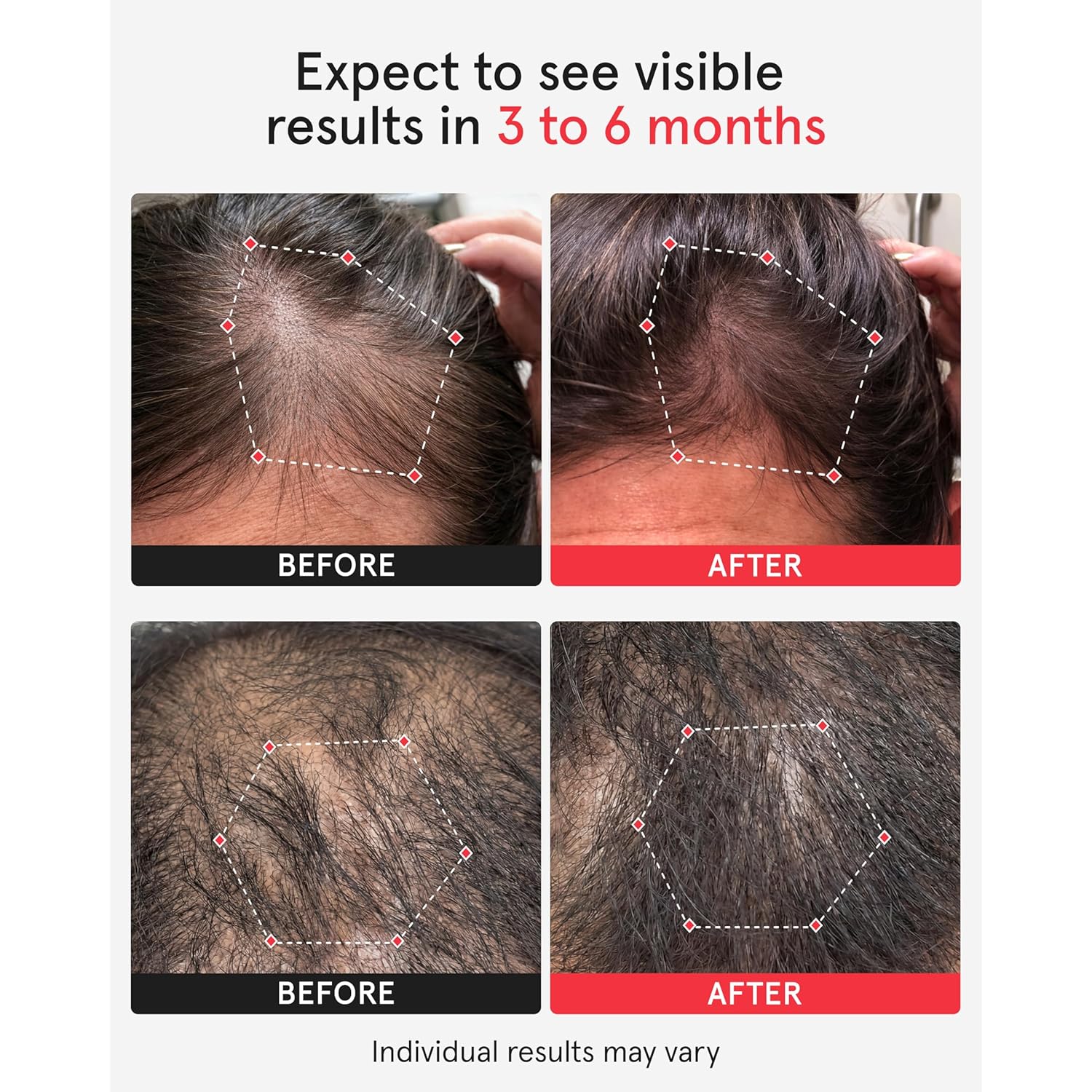 iRestore Professional Laser Red Light Therapy for Hair Growth System - FDA Cleared Hair Loss, Hair Thinning & Alopecia Treatment for Men & Women - 282 Lasers & LEDs