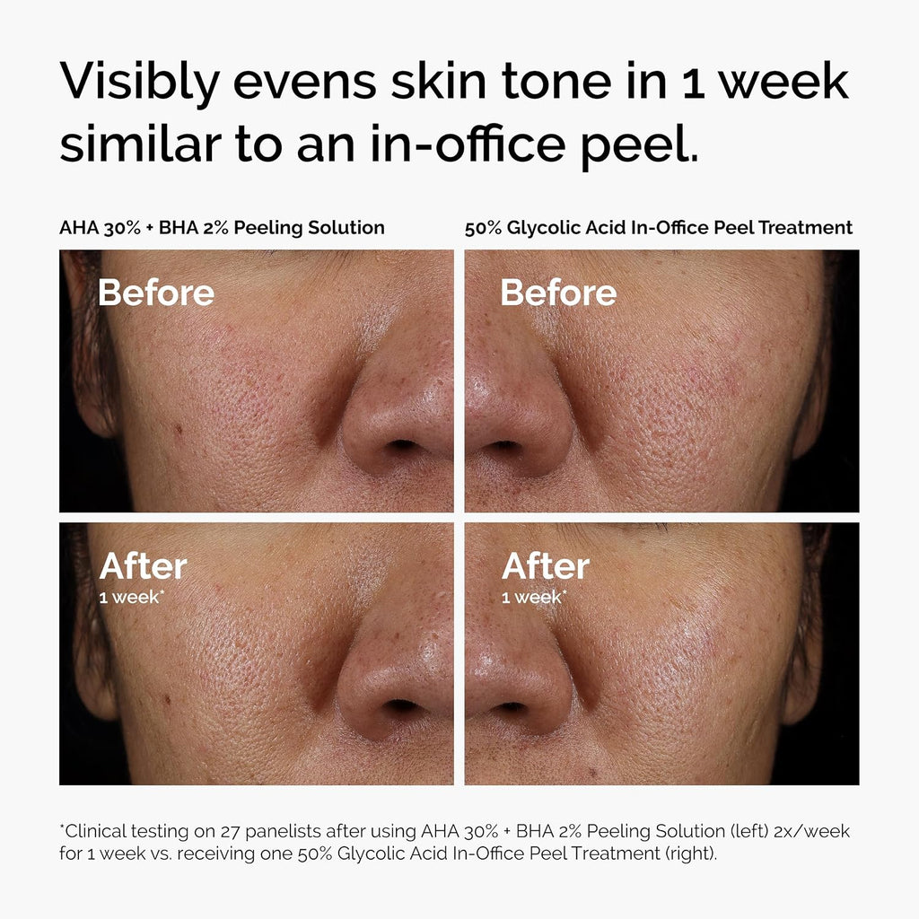 The Ordinary Aha 30% + Bha 2% Peeling Solution, Advanced Exfoliating Peel For Brighter Skin